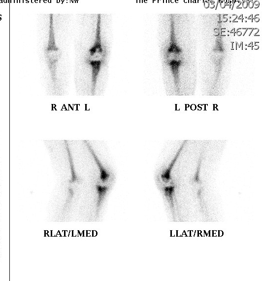 White Cell Scan Infected TKR